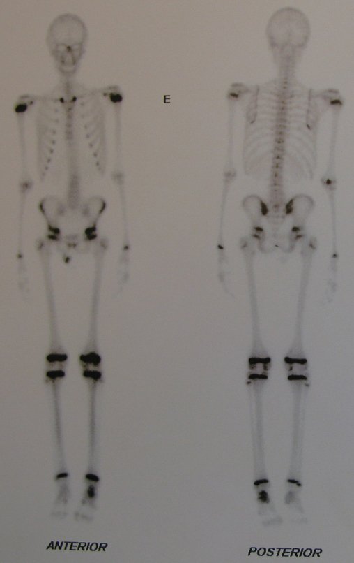 Figura 6: Cintilografia óssea, na fase tardia, constata tratar-se de lesão única.