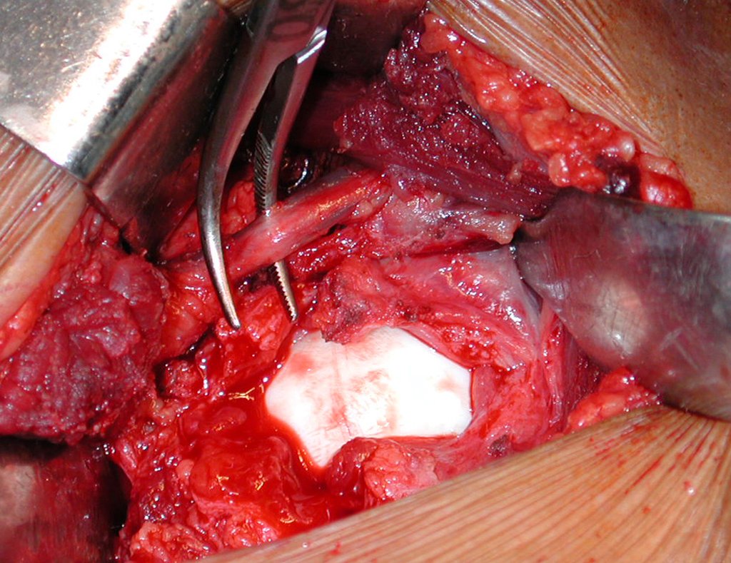 Figura 23: Ligadura dos vasos circunflexos mediais, para ampliar a exposição do acesso ao colo femoral distalmente.