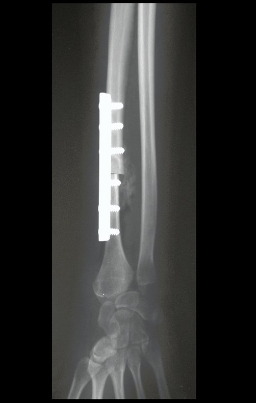 Figura 91: Radiografia, perfil, da fixação e do enxerto no pós operatório imediato.