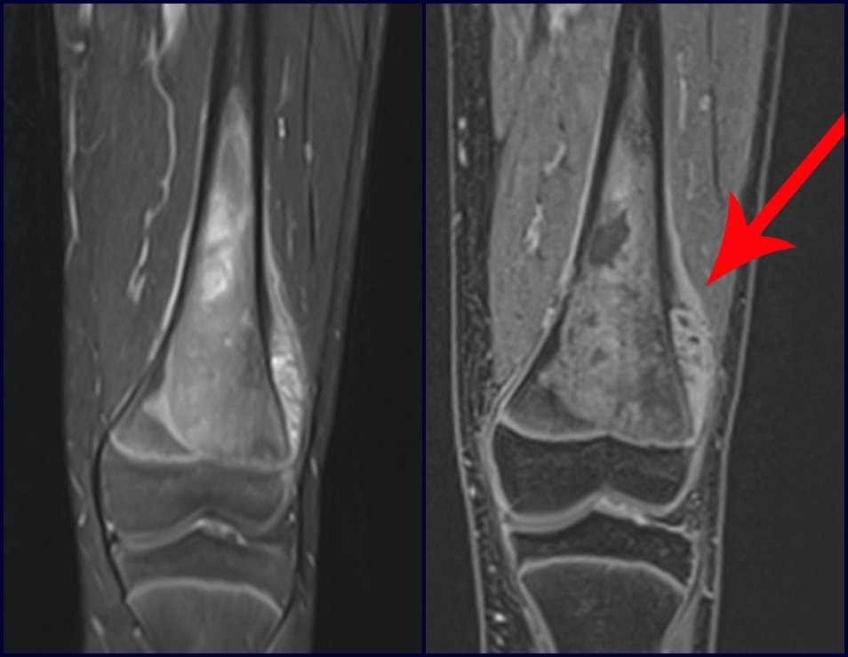 Figura 117: Ressonância coronal T1, com supressão de gordura destacando a extensão medular da lesão, que compromete a cartilagem de crescimento.