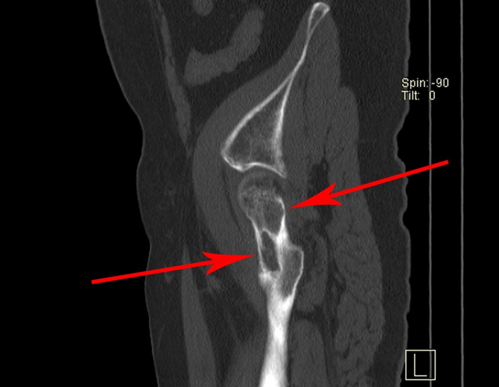 Figura 70: Tomografia sagital, as setas em vermelho apontam as duas grandes lesões líticas no colo femoral, fragilizando-o e propiciando a ocorrência de fratura.