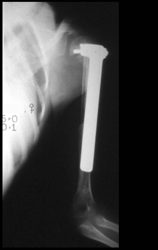 Figura 16: Radiografia de controle em 15/07/1991, perfil.