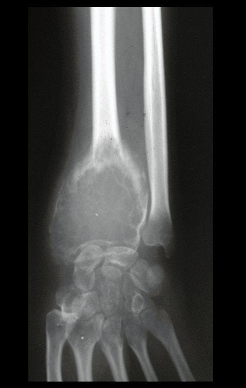 Figura 11: Grande erosão da cortical radial e também do lado ulnar, que se encontrava preservada dez meses antes.