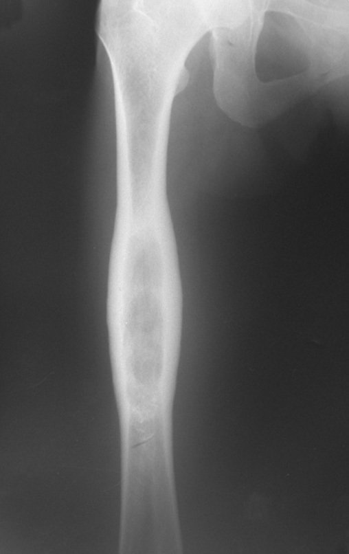 Figura 47: Lesão radiotransparente, com erosão da cortical interna em saca bocado, insuflação, expansão da porção medular do osso e focos de calcificação salpicados.