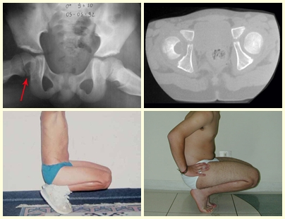 Condroblastoma da cabeça femoral – Lesão intra-articular – Pós operatório de 1 ano – Pós operatório de 8 anos