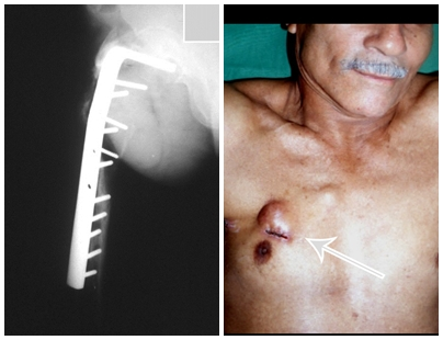 Fig. 5a e 5b – Quebra da plca. Realizada biópsia incisional do nódulo que o paciente apresentava na mama direita. O diagnóstico anatomopatológico foi de carcinoma ductal infiltrativo.