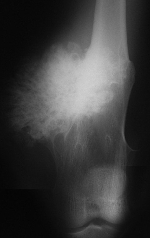 Figura 82: Radiografia do fêmur esquerdo com volumoso osteocondroma séssil, com a superfície externa borrada, sem contornos nítidos.