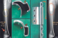 Fig. 3 – Após 8 meses da 1ª cirurgia – peças de aço inoxidável – encaixe da placa permitindo o deslizamento – RX após a 2ª cirurgia.