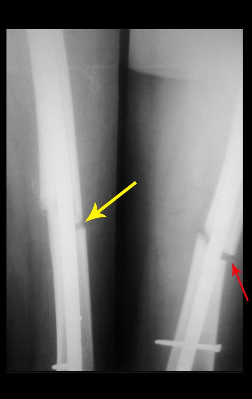 Figura 8: Diastase na diáfise femoral, a seta amarela destaca o perfil e a seta vermelha o grande afastamento na imagem de frente. O parafuso de bloqueio impede a rotação, mas também a compressão dos fragmentos, dificultando a consolidação.