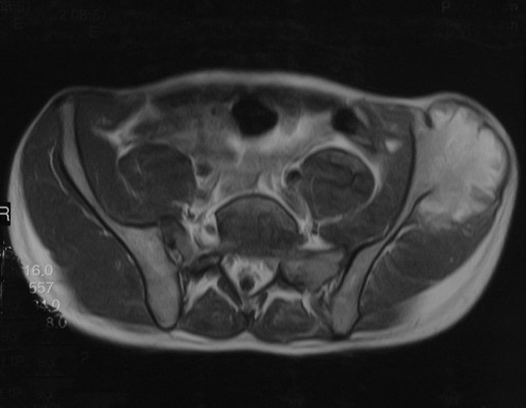 Figura 65: A biópsia nem sempre é positiva e deve-se operar com margem oncológica, pois há áreas de osteocondroma e áreas de condrossarcoma.