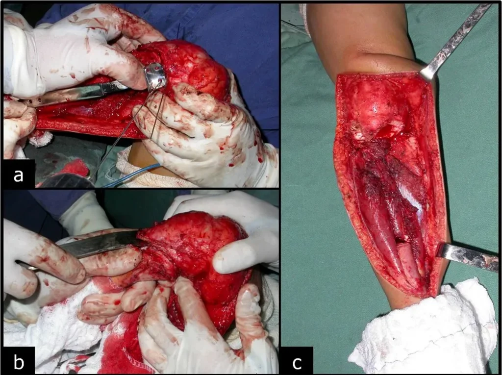 Figura 3: a- Passagem de fio guia na epífise e verificação da posição da placa, b- Separação da epífise tibial do tumor, por osteotomia transepifisária e c- Após a ressecção do tumor.