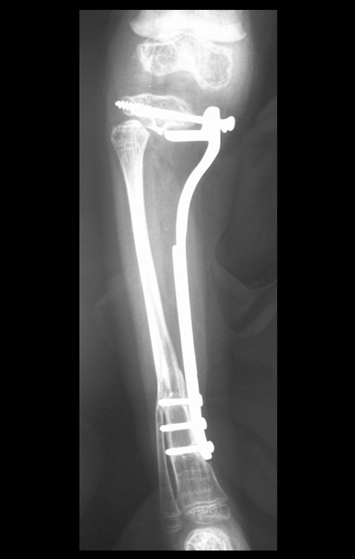 Figura 7d: Radiografia com 6 meses, evidenciando a hipertrofia da fíbula.