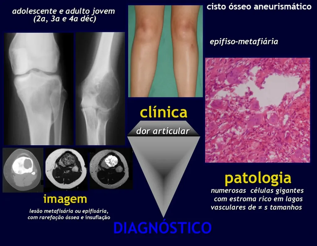 Diagrama do cisto ósseo aneurismático