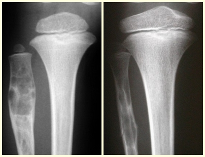 Figura 70 crescimento ósseo metafisário e “migração” da lesão em direção à diáfise. Fig. 71 Cicatriz de COS que foi distanciando-se da placa de crescimento que teve cura expontânea.