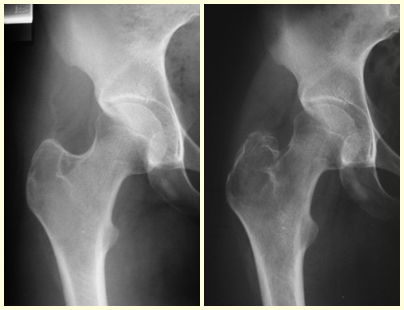 3 – condroblastoma da apófise do grande trocânter. Fig. 4 – aumento significativo da lesão, com fratura arrancamento do grande trocânter.