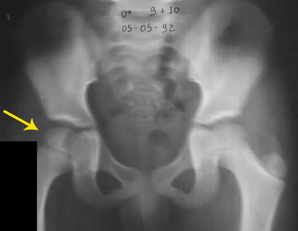 Fig. 5- Condroblastoma da região medial da cabeça femoral direita.