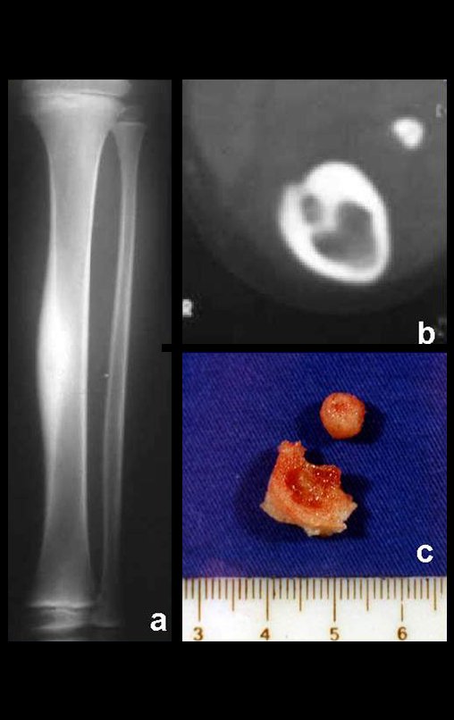 Figura 2: Aumento de densidade da cortical medial, devido à esclerose óssea (a); corte tomográfico mostrando a lesão de rarefação na cortical, circundada por halo de esclerose (b) e nicho de osteoma osteóide com a esclerose, já ressecado (c).