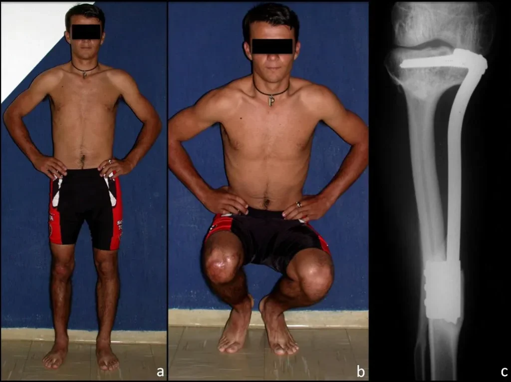 Figura 9: a) paciente com 3 anos e 7 meses de pós-operatório, com carga total, b) com 3 anos e 7 meses, flexão com carga e boa função dos joelhos, e c) radiografia com 3 anos e 7 meses, fibula hipertrofiada, já totalmente tibializada.