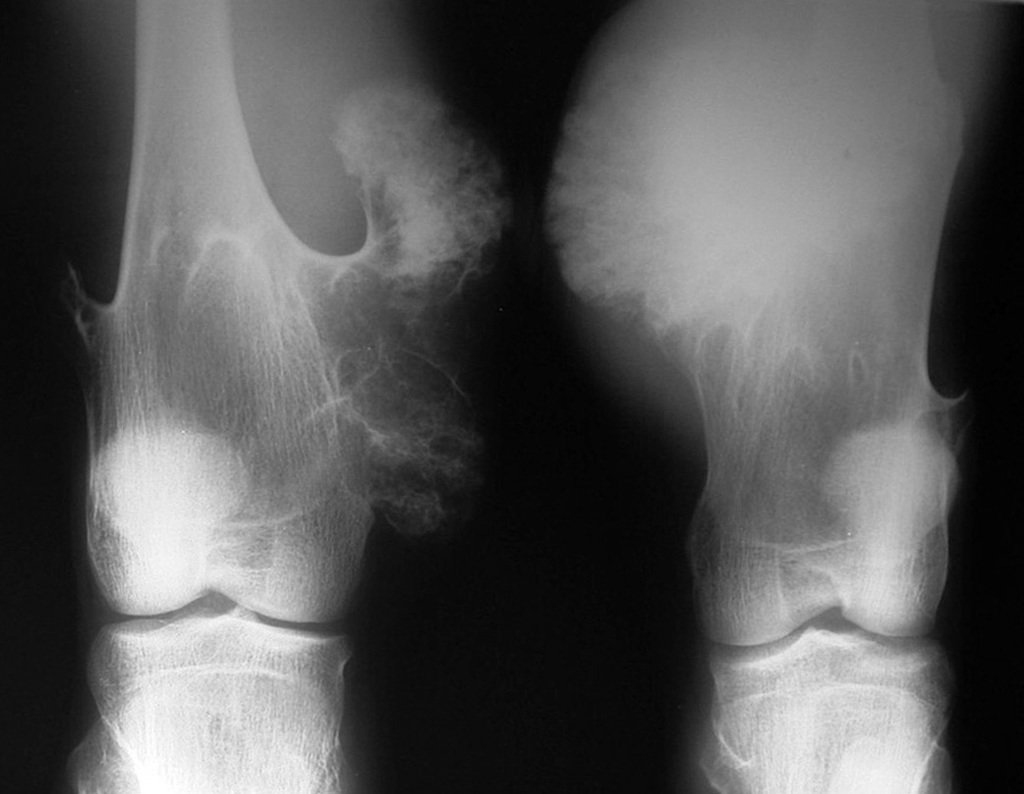 Figura 18: Condrossarcoma periférico do fêmur esquerdo, secundário à malignização de osteocondromatose. Observe os osteocondromas na região metafisáriado fêmur direito (um pediculado na face lateral e outro séssil medialmente).