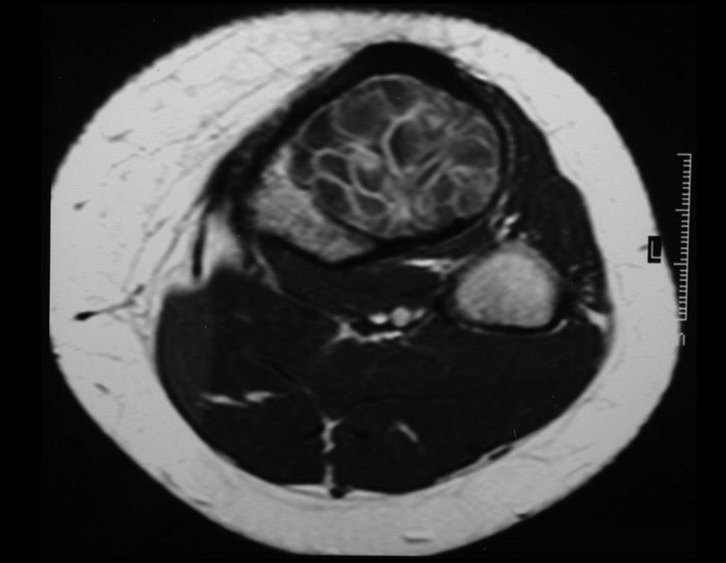 Figura 2 - Rm. axial T1. cisto ósseo aneurismático da tíbia.