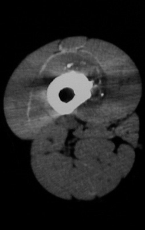 Figura 54: Tomografia com densidade para tecidos moles, evidenciando calcificações na musculatura da coxa e tumor heterogênio.