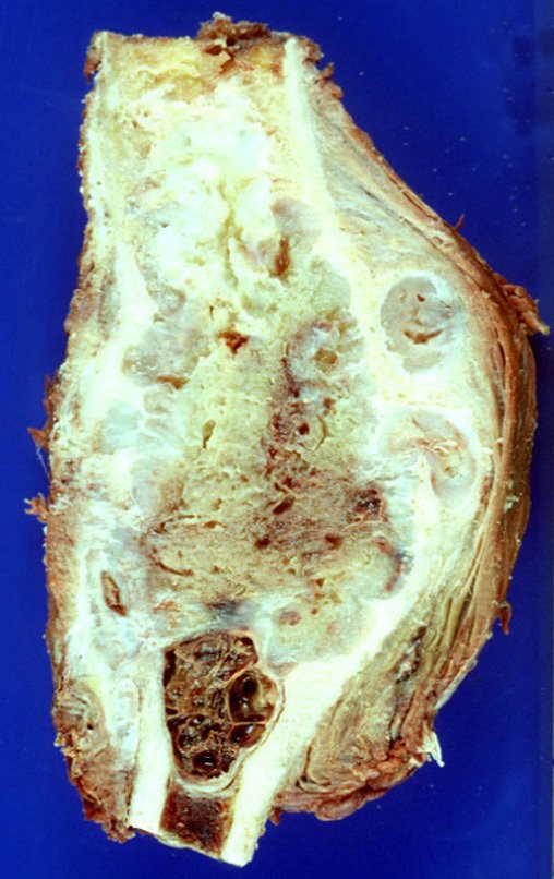 Figura 46: coloração branco-azulada, focos de calcificação e lóbulos. Neste caso houve erosão da cortical e extravazamento do tumor.