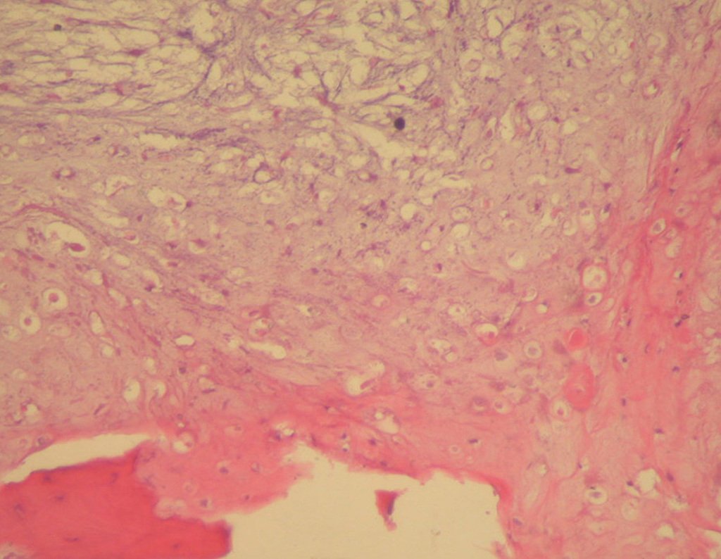 Figura 51: Histologia do caso anterior com grau moderado de atipia celular. Condrossarcoma grau I / II.