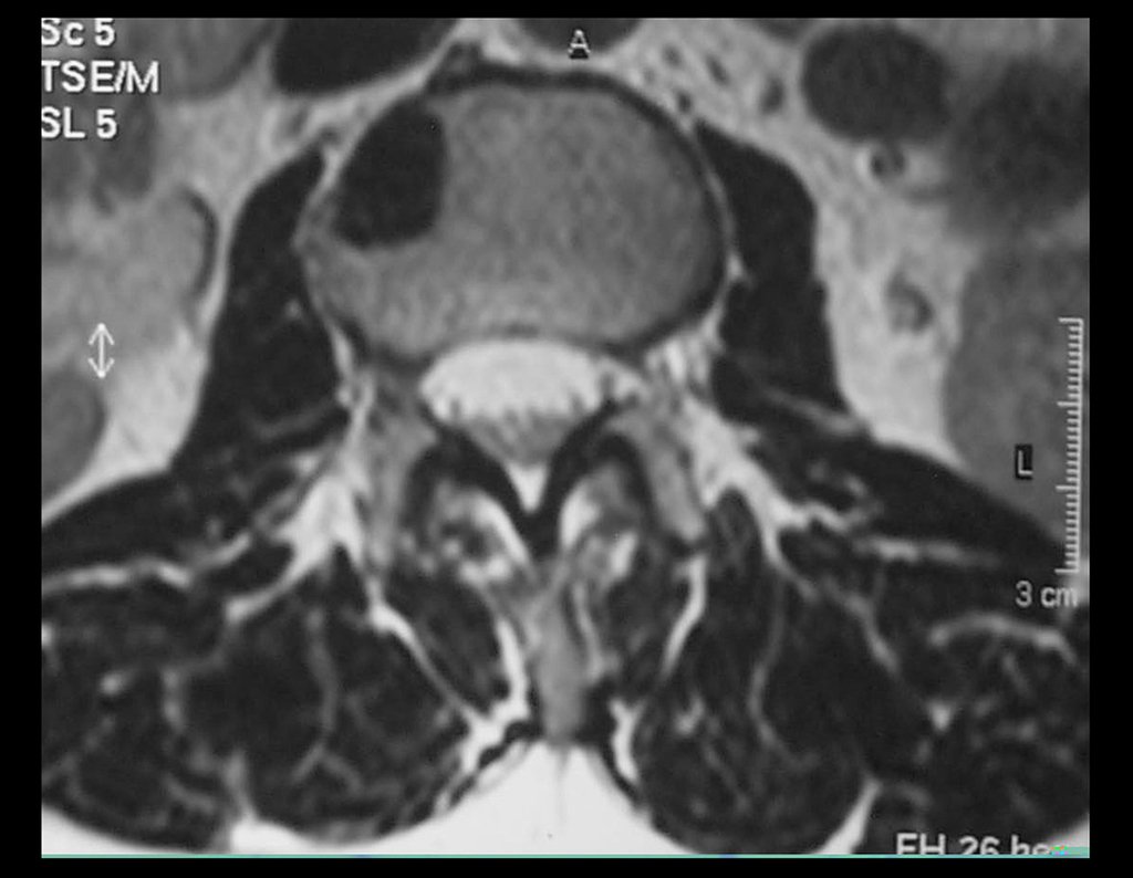 Figura 16: Rm axial de osteoma medular do corpo vertebral.