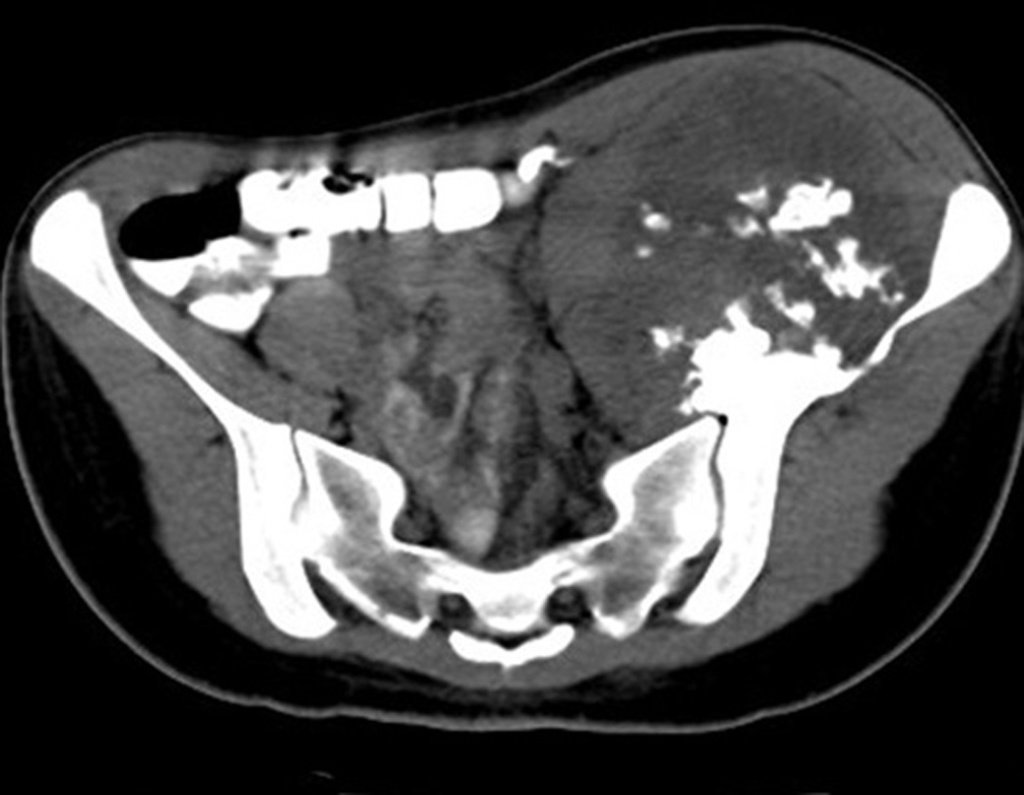 8: Tomografia com focos de calcificação.