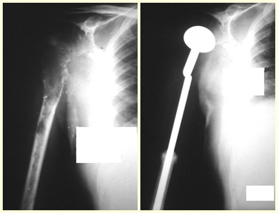 Figura 12: Destruição completa do 1/3 proximal do úmero. Figura 13: Reconstrução com endoprótese.
