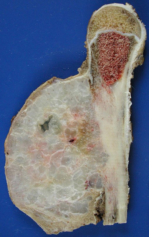 Figura 17: Corte da peça evidenciando lesão cartilaginosa com erosão da cortical. O periósteo contorna externamente o tumor.