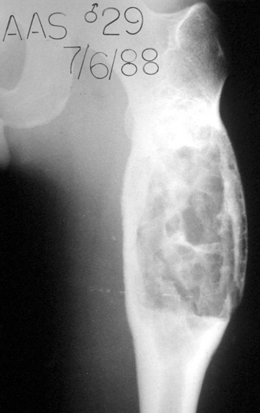 Figura 45: Lesão radiotransparente, erosão da cortical interna, insuflação e expansão da porção medular do osso com espessamento da cortical medial.