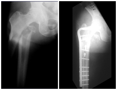 Fig. 1 e 2 – Radiografias do fêmur proximal direito, com fratura, realizadas à admissão do paciente. Rx após osteossíntese