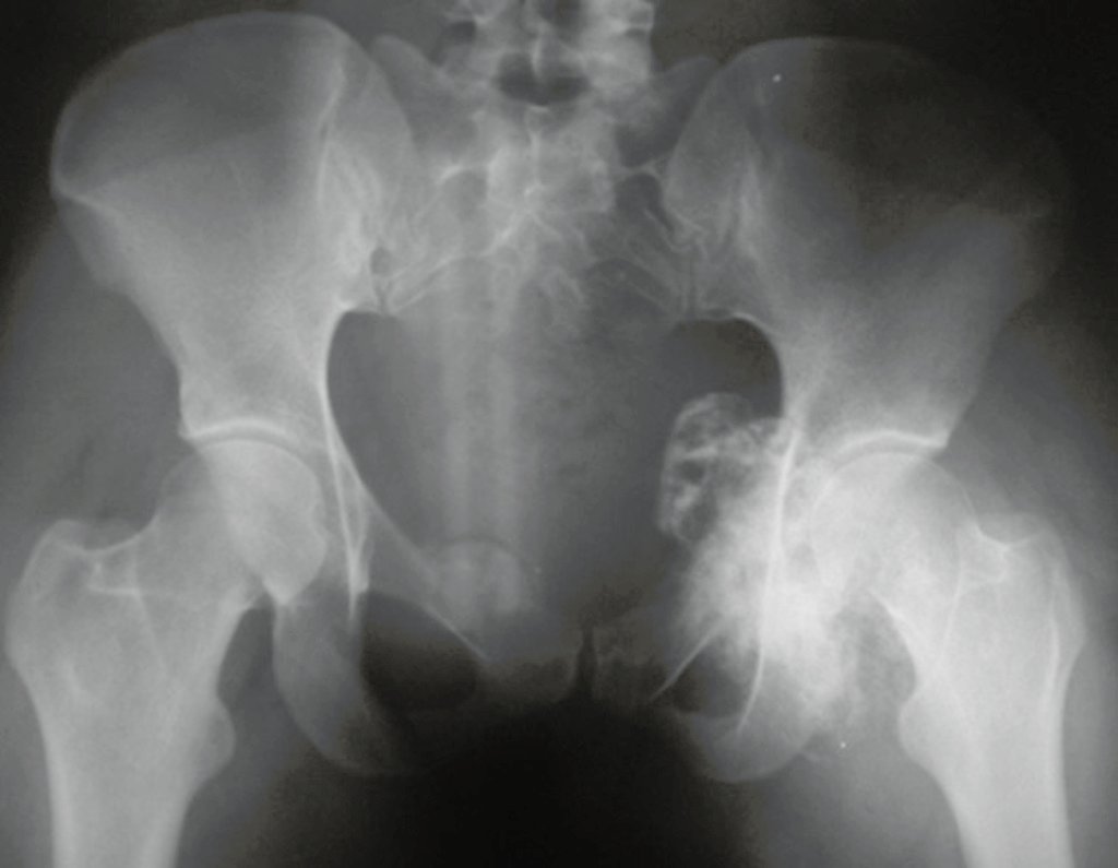 Figura 67: Na hemipelve esquerda trata-se de condrossarcoma.