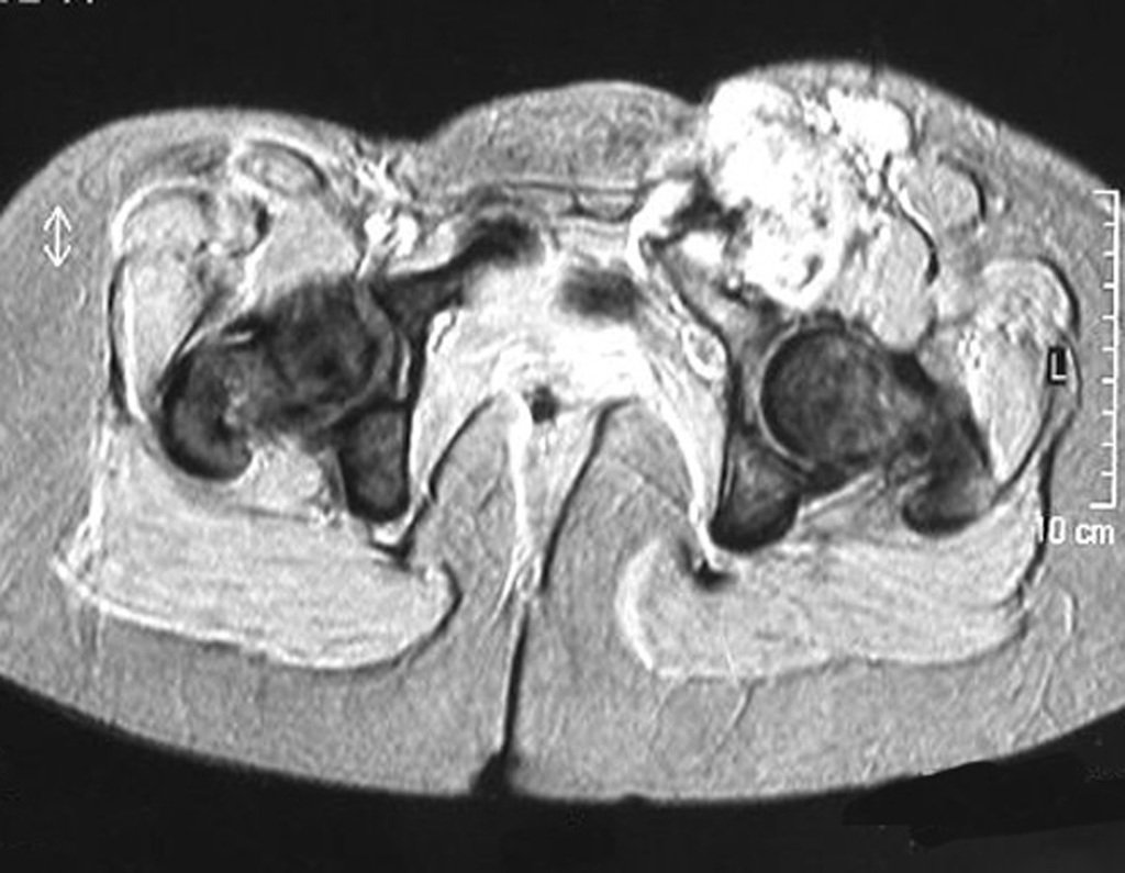 Figura 74: Em FFE destaca-se alguns focos de calcificação.