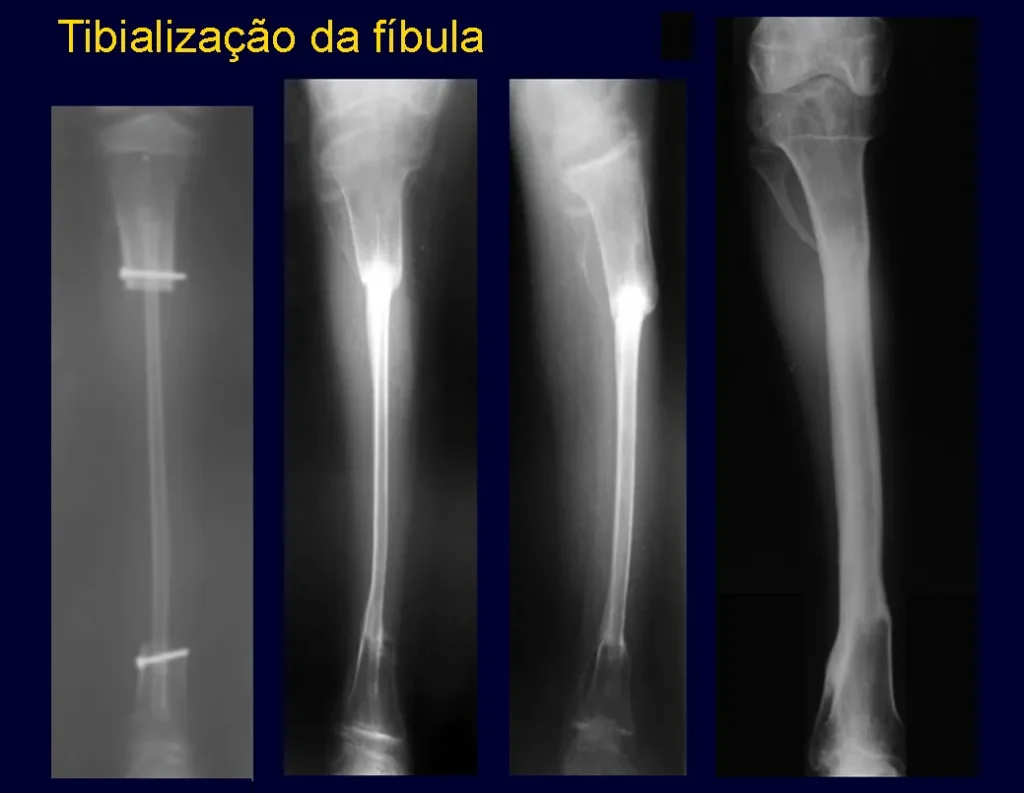 Pós operatório imediato; consolidação e espessamento da fíbula rx frente; Rx perfil; fíbula completamente tibializada.