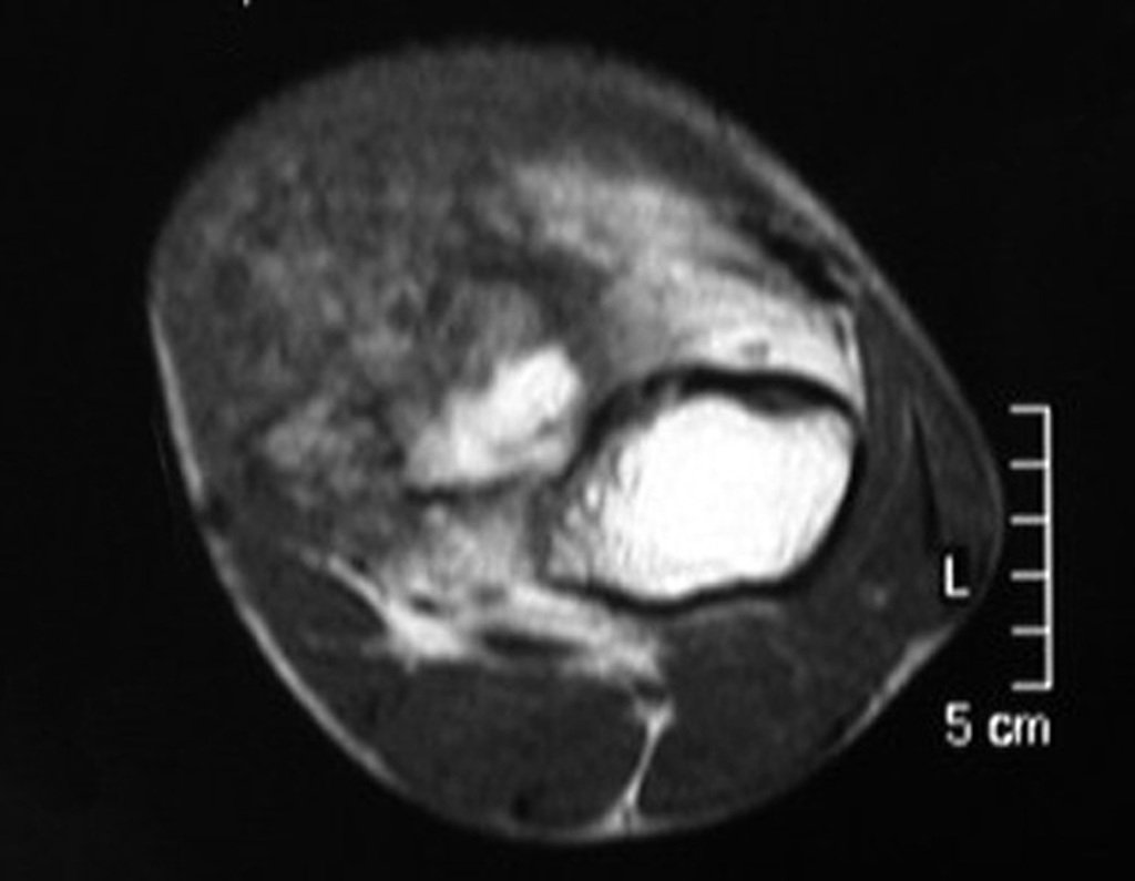 Figura 85: Tumor na face medial, áreas de baixo sinal.