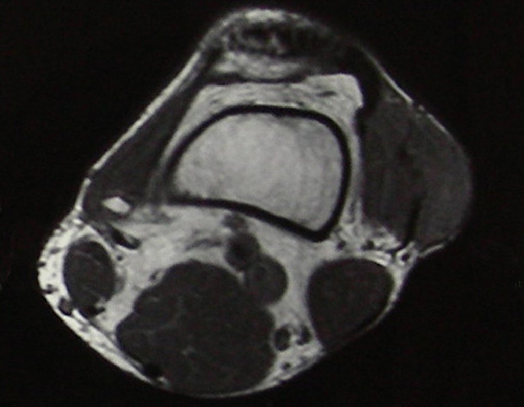 Figura 28: RM de Condrossarcoma extra ósseo. Cortes axiais,com lesão apresentando baixo sinal em T1, acometendo a fascia lata.