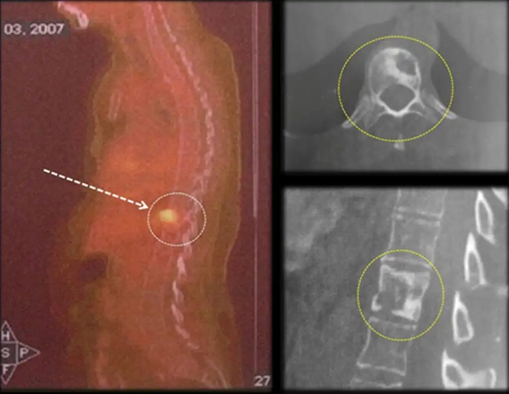 Figura 19: a- Pet-Cet. com imagem evidenciando a lesão na vértebra torácica T11. b- Tomografia com a lesão na vértebra torácica T11.