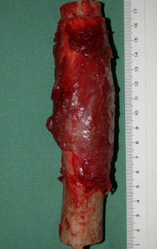 Figura 49: foto de segmento da diáfise femoral. A cirurgia com ressecção oncológica é o procedimento mais importante para a cura deste tumor.