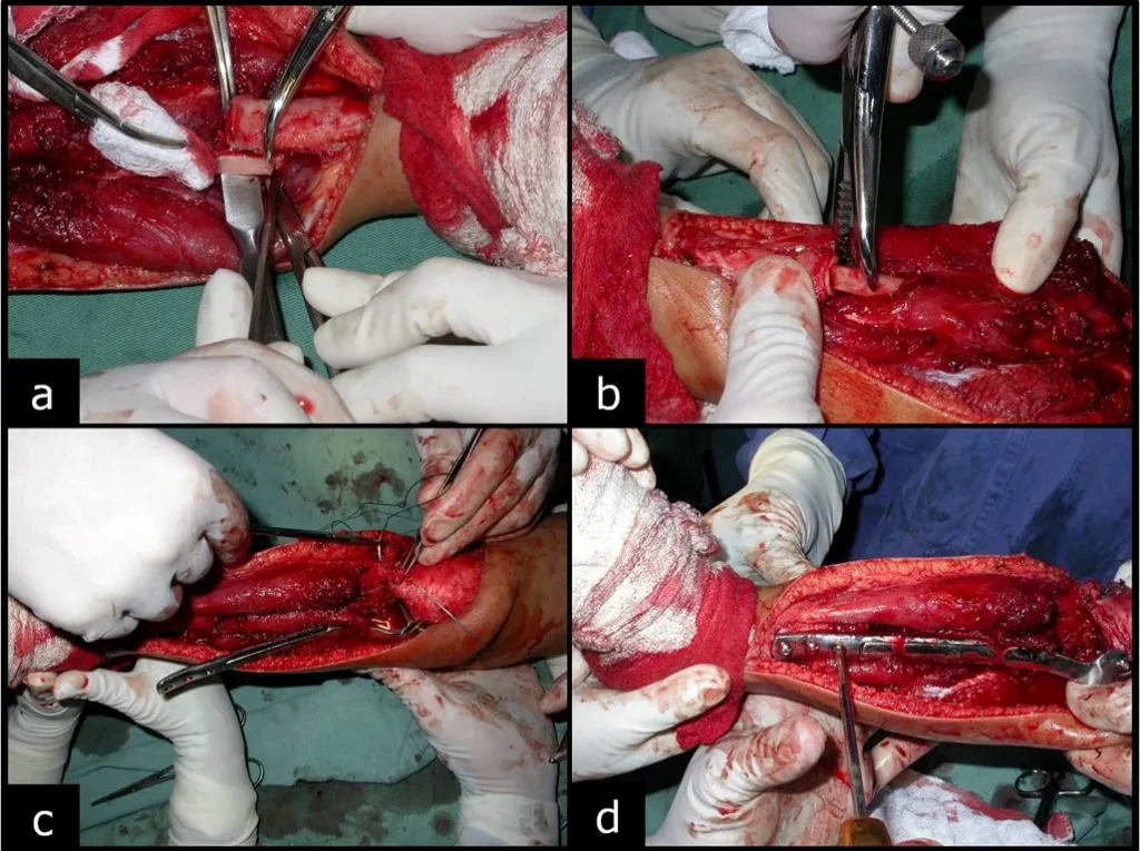 Figura 4: a- Pequena desperiostização da fíbula, b- encavilhamento desta no canal medular da tíbia, c- posicionamento da fíbula sob o planato tibial com reinseção do ligamento lateral e d- osteossíntese proximal e distal com parafusos.