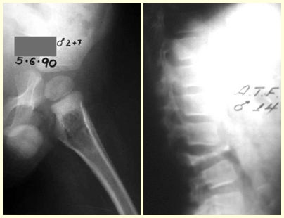 37 – reação periosteal lamelar grossa em granuloma eosinófilo. Não há lesão extra-óssea. Fig. 38 – vértebra plana de Calvé (fratura acunhamento do corpo vertebral em granuloma eosinófilo).