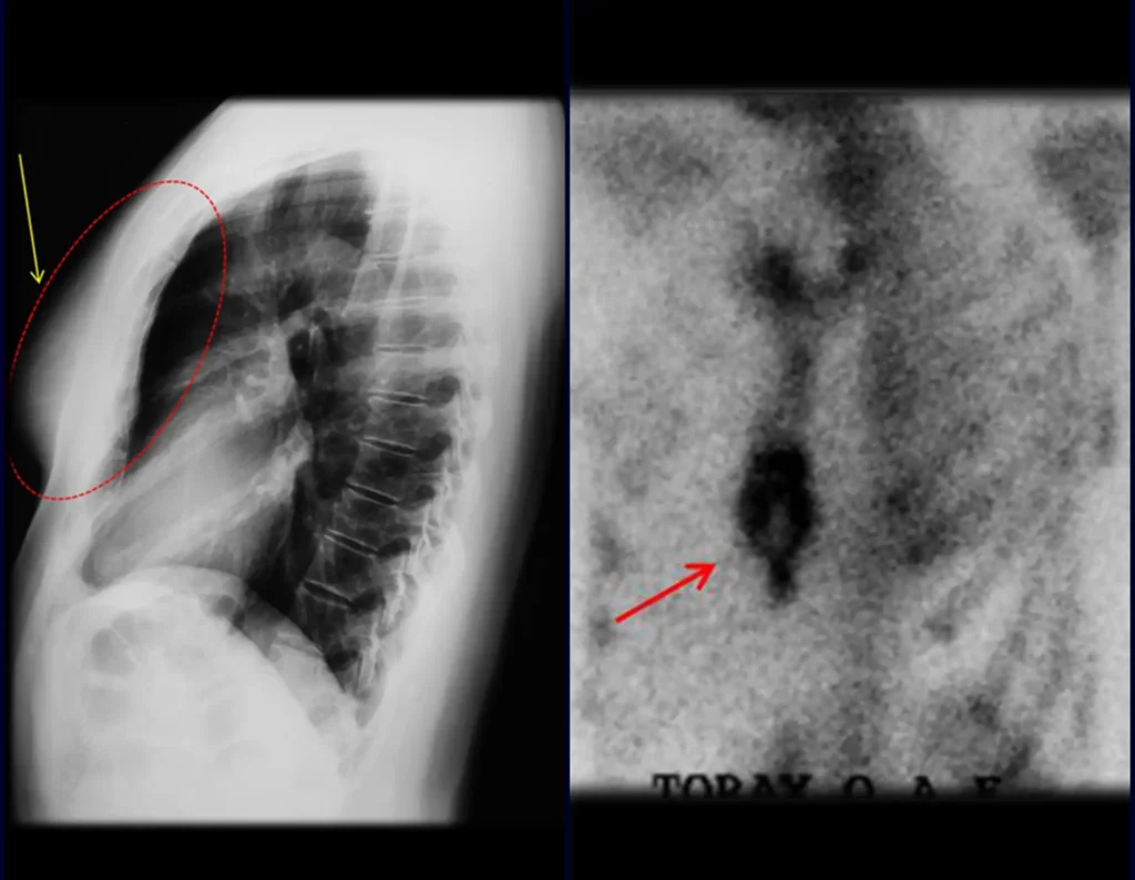 Figura 15: a- Radiografia de tórax, em perfil, evidencia lesão expansiva no esterno. b- A cintilografia apresenta intensa captação na metade inferior do esterno.