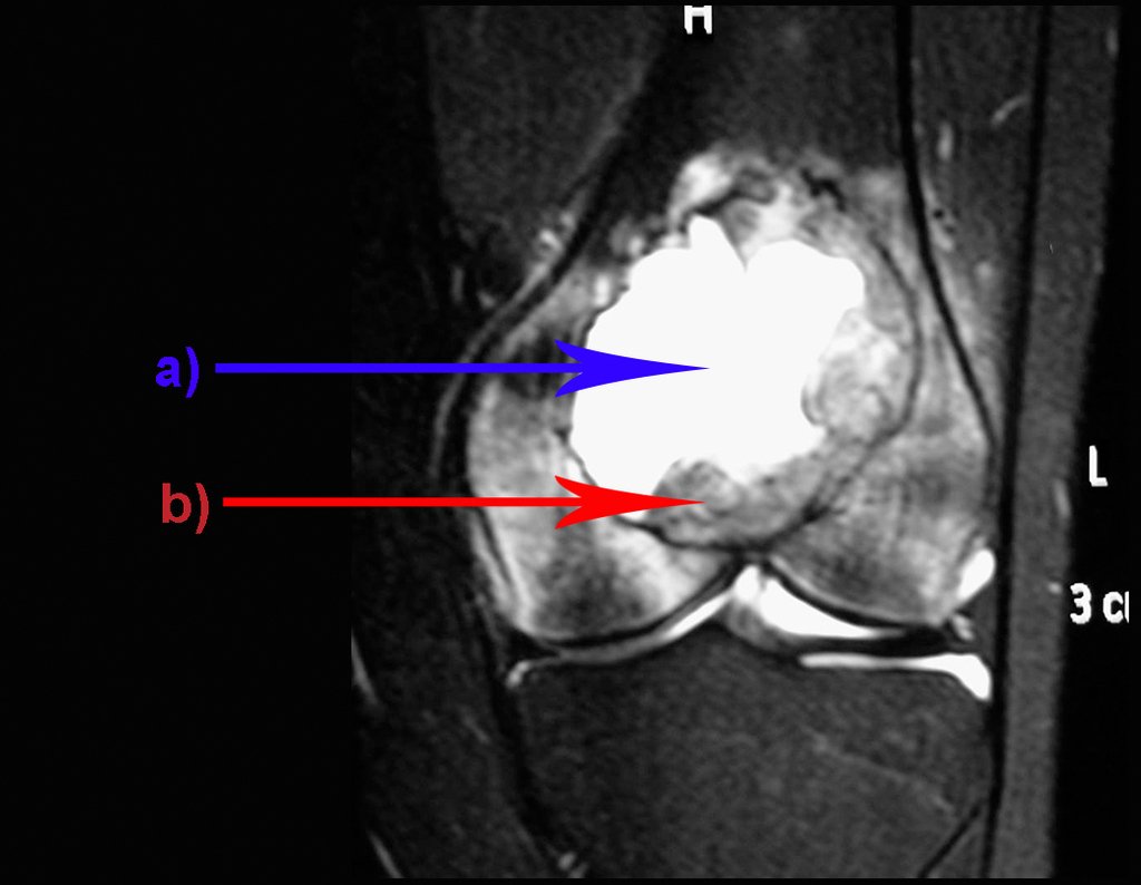 Figura 3: Tumor de células gigantes do fêmur, com área de cisto ósseo aneurismatico. A escolha do local de biópsia deve permitir a obtenção de amostra representativa da heterogeneidade da lesão. A) COA ; B) TGC