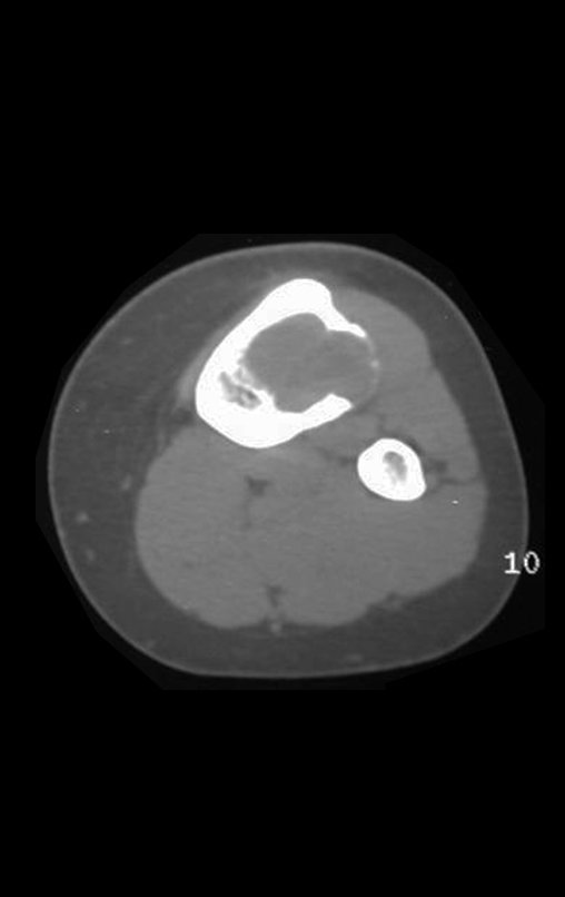 Figura 7: A tomografia revela área radiolucente; erosão óssea; afilamento da cortical e insuflação. sem focos de calcificação.