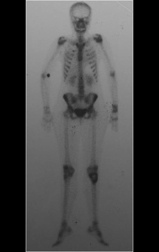 Figura 6: No estadiamento ósseo realizado com a cintilografia encontramos lesão única com captação discreta na periferia da lesão.