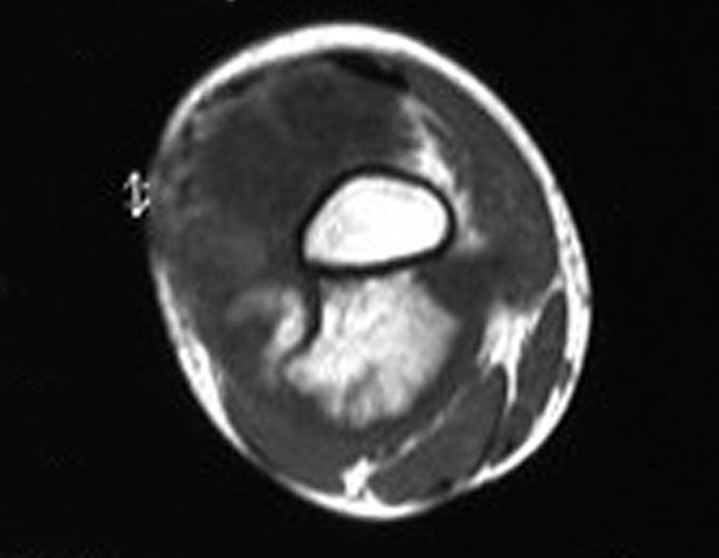 Figura 58: RM em T1 verificamos o comprometimento anterior, lateral e posterior extracortical