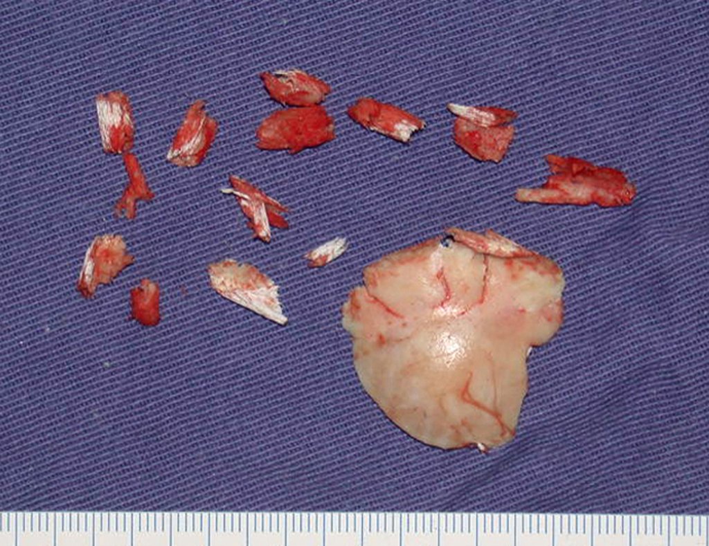 Figura 8: Fragmentos do osteoma ressecado.