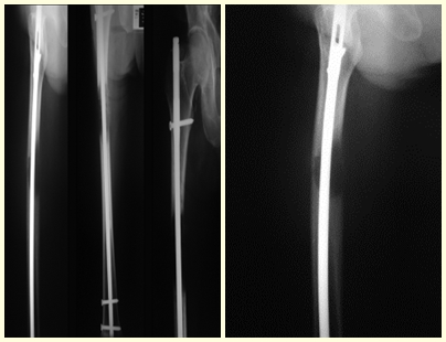 Figura 26: Osteossíntese, sem ressecção da lesão. Figura 27: Progressão da lesão, dor e incapacidade de caminhar.