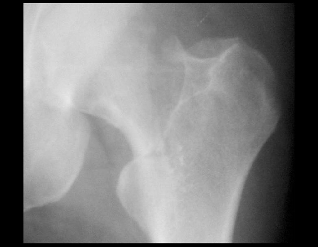 Figura 3: Radiografia focalizada do quadril esquerdo, destacando o colo femoral.